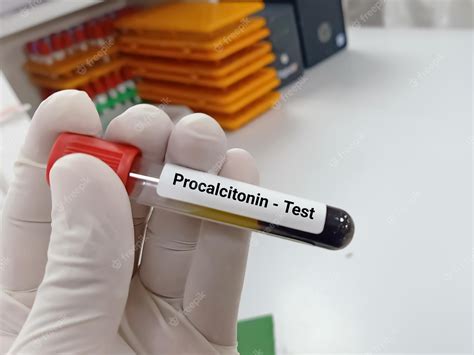 Procalcitonin (PCT) Test .